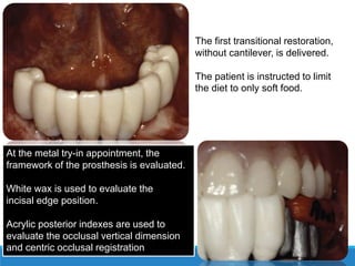 The first transitional restoration,
without cantilever, is delivered.
The patient is instructed to limit
the diet to only soft food.
At the metal try-in appointment, the
framework of the prosthesis is evaluated.
White wax is used to evaluate the
incisal edge position.
Acrylic posterior indexes are used to
evaluate the occlusal vertical dimension
and centric occlusal registration
 