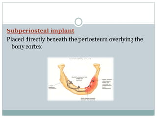 Subperiosteal implant 
Placed directly beneath the periosteum overlying the 
bony cortex 
 
