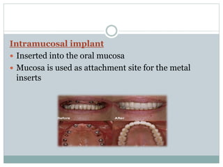 Intramucosal implant 
 Inserted into the oral mucosa 
 Mucosa is used as attachment site for the metal 
inserts 
 