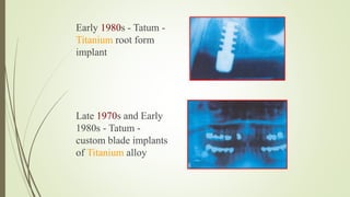Early 1980s - Tatum -
Titanium root form
implant
Late 1970s and Early
1980s - Tatum -
custom blade implants
of Titanium alloy
 