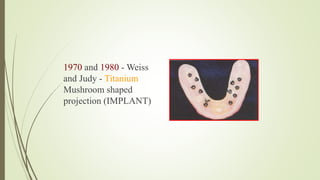 1970 and 1980 - Weiss
and Judy - Titanium
Mushroom shaped
projection (IMPLANT)
 