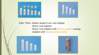 After 1980s –hollow basket Core vent implant
Screw vent implant
Screw vent implant with Hydroxyapatite coating
implant with titanium plasma spray
 