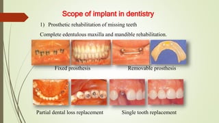 Scope of implant in dentistry
1) Prosthetic rehabilitation of missing teeth
Complete edentulous maxilla and mandible rehabilitation.
Single tooth replacement
Partial dental loss replacement
Removable prosthesis
Fixed prosthesis
 