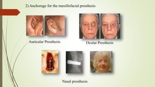 2) Anchorage for the maxillofacial prosthesis
Auricular Prosthesis Ocular Prosthesis
Nasal prosthesis
 