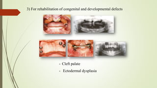 3) For rehabilitation of congenital and developmental defects
- Cleft palate
- Ectodermal dysplasia
 