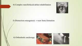 4) Complex maxillofacial defect rehabilitation
6) Orthodontic anchorage.
5) Distraction osteogenesis  new bone formation
 