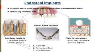  An implant which is placed into the alveolar bone/basal bone of the mandible or maxilla
 Transect only one cortical plate
32
 