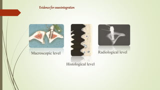 Evidence for osseointegration
Macroscopic level
Histological level
Radiological level
 