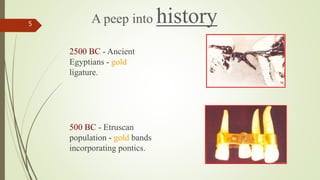 A peep into history
5
2500 BC - Ancient
Egyptians - gold
ligature.
500 BC - Etruscan
population - gold bands
incorporating pontics.
 