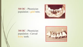 500 BC - Phoenician
population - gold wire.
300 BC - Phoenician
population - Carved
Ivory teeth.
 