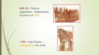 600 AD - Mayan
population - implantation
of pieces of shell.
1700 - John Hunter -
transplanting the teeth.
 