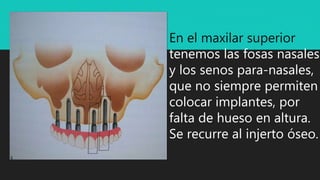 En el maxilar superior
tenemos las fosas nasales
y los senos para-nasales,
que no siempre permiten
colocar implantes, por
falta de hueso en altura.
Se recurre al injerto óseo.
 