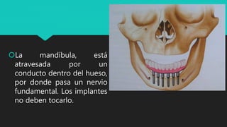 La mandíbula, está
atravesada por un
conducto dentro del hueso,
por donde pasa un nervio
fundamental. Los implantes
no deben tocarlo.
 