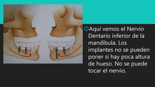 Aquí vemos el Nervio
Dentario inferior de la
mandíbula. Los
implantes no se pueden
poner si hay poca altura
de hueso. No se puede
tocar el nervio.
 