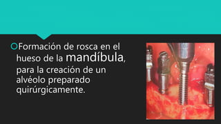 Formación de rosca en el
hueso de la mandíbula,
para la creación de un
alvéolo preparado
quirúrgicamente.
 