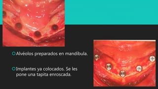 Alvéolos preparados en mandíbula.
Implantes ya colocados. Se les
pone una tapita enroscada.
 