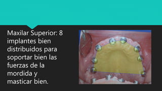 Maxilar Superior: 8
implantes bien
distribuidos para
soportar bien las
fuerzas de la
mordida y
masticar bien.
 