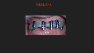 FERULIZAR
 
