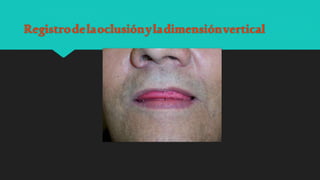 Registrodelaoclusiónyladimensiónvertical
 