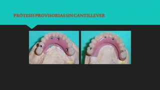 PRÓTESISPROVISORIASSINCANTILLEVER
 