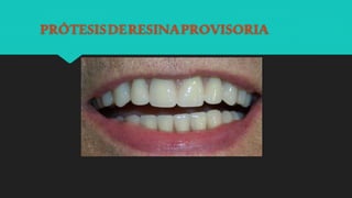 PRÓTESISDERESINAPROVISORIA
 