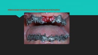 FERULIZARCONDURALAYPARATENERAJUSTEPASIVO
 