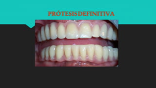 PRÓTESISDEFINITIVA
 