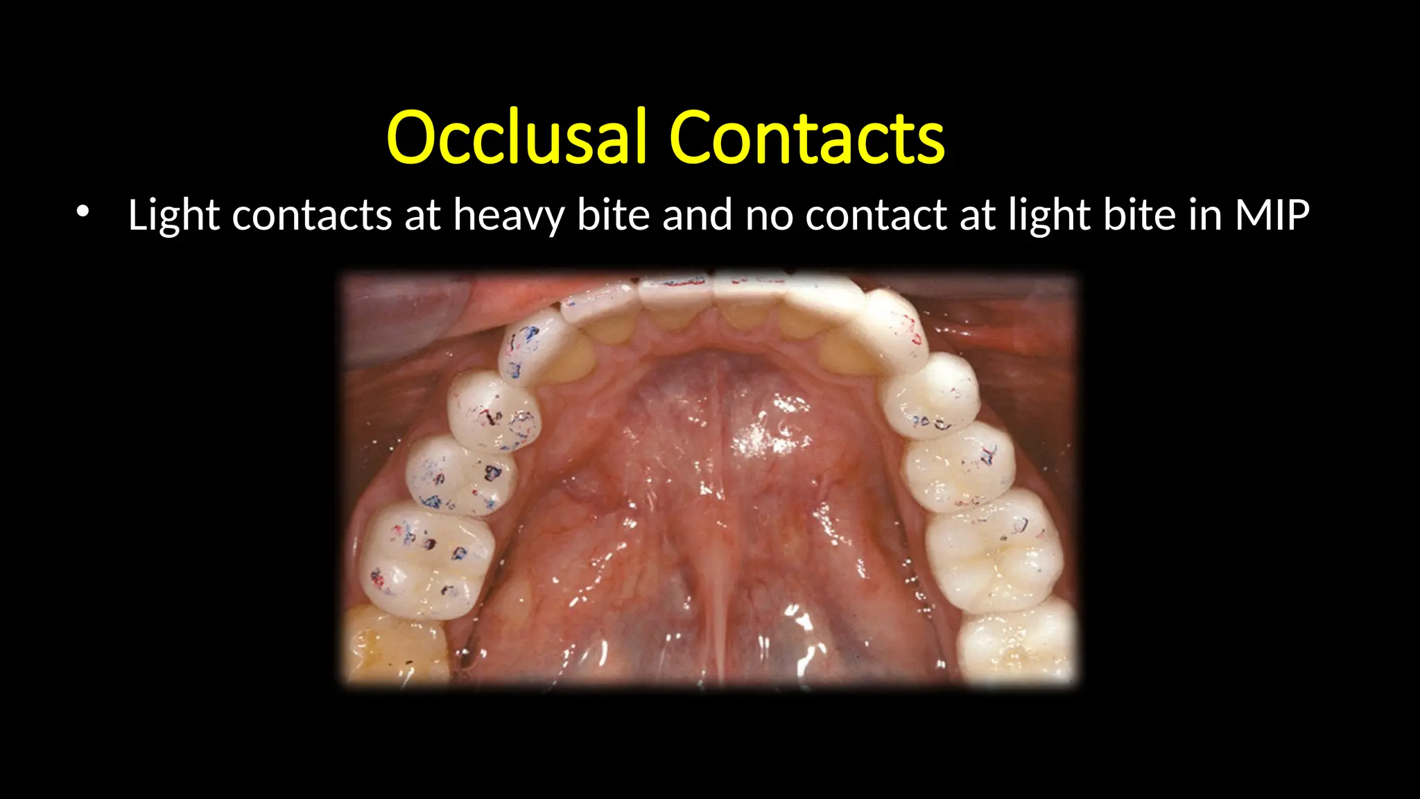 Implant occlusion necessary in implant dentistry | PPTX