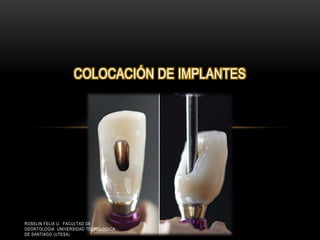 COLOCACIÓN DE IMPLANTES
ROSELIN FELIX U. FACULTAD DE
ODONTOLOGIA UNIVERSIDAD TECNOLOGICA
DE SANTIAGO (UTESA)
 