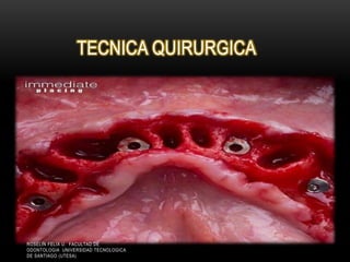 TECNICA QUIRURGICA
ROSELIN FELIX U. FACULTAD DE
ODONTOLOGIA UNIVERSIDAD TECNOLOGICA
DE SANTIAGO (UTESA)
 