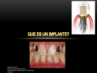 QUE ES UN IMPLANTE?
ROSELIN FELIX U.
FACULTAD DE ODONTOLOGIA
UNIVERSIDAD TECNOLOGICA DE SANTIAGO
(UTESA)
 