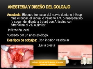 ANESTESIA Y DISEÑO DEL COLGAJO
Anestesia: Bloqueo troncular del nervio dentario inf/sup
mas el bucal, el lingual o Palatino Ant. o nasopalatino
(a segun del diente a tratar) con Articaína con
adrenalina al 2% o similar
Infiltración local
*Sedado por un anestesiólogo.
Dos tipos de colgajos: .Con incisión vestibular
.En la cresta
Incision convergente puede provocar
zonas de necrosisROSELIN FELIX U. FACULTAD DE
ODONTOLOGIA UNIVERSIDAD TECNOLOGICA
DE SANTIAGO (UTESA)
 
