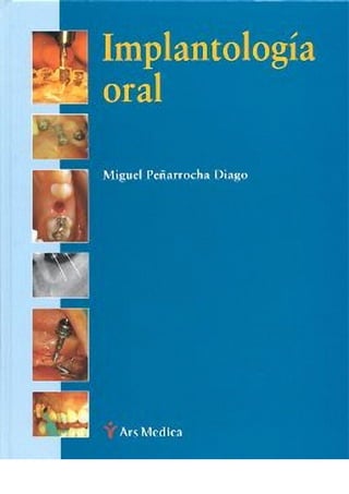 Implantologia oral   peñarocha