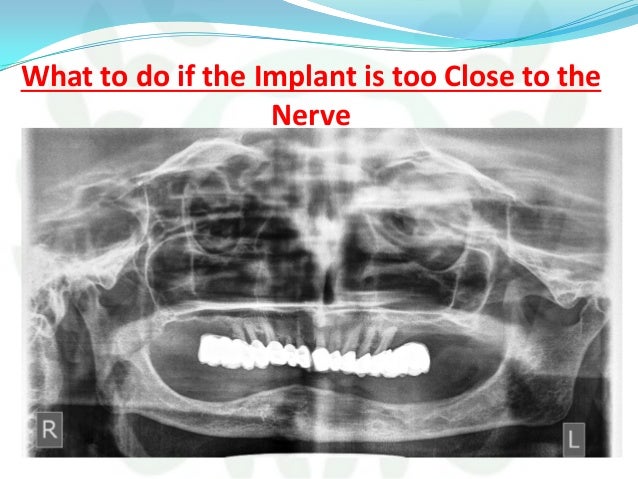 implant implantology simplified