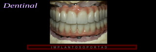 I M P L A N T O S O P O R T A D 
 