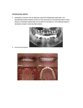 INTRAMUCOSAL INSERTS
REPRESENT A FOURTH TYPE OF IMPLANT USED WITH REMOVABLE DENTURES. THE
MUSHROOM-SHAPED INSERTS ATTACH TO THE GUM-SIDE OF THE DENTURE AND FIT INTO
SPECIALLY PREPARED INDENTIONS IN THE ROOF OF THE MOUTH. THEY PROVIDE GREATLY
INCREASED STABILITY AND HOLDING POWER.
Intramucosal implants
 