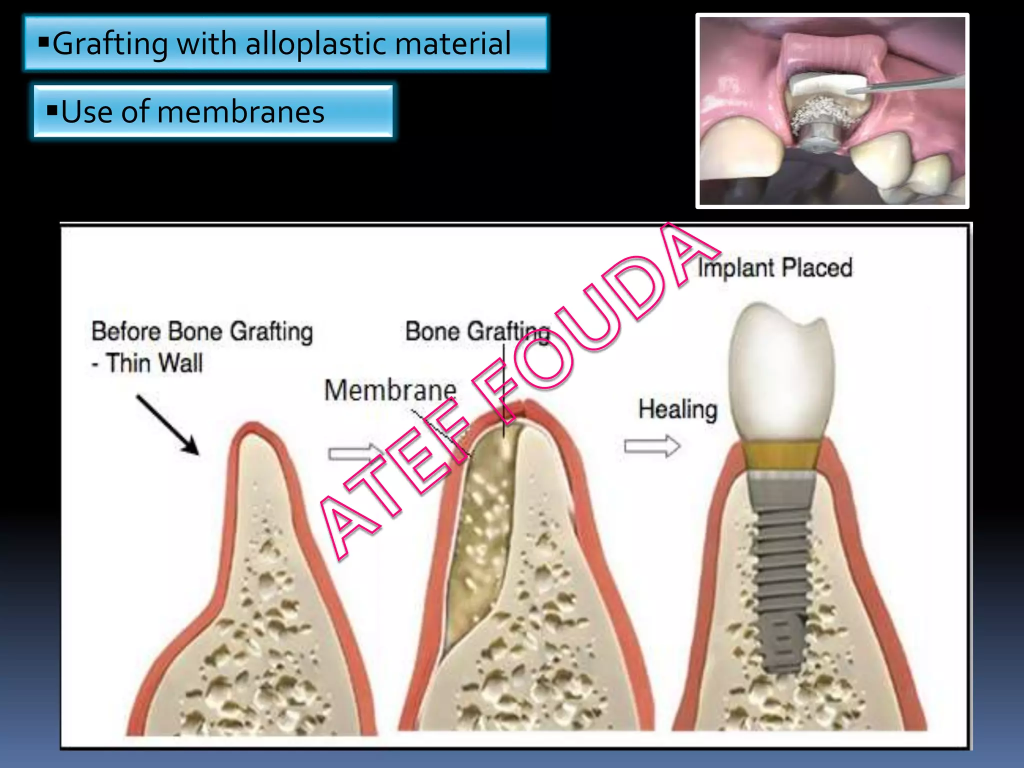 Baic dental implantology and Implant related surgery