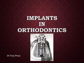 IMPLANTSIMPLANTS
ININ
ORTHODONTICSORTHODONTICS
Dr Tony Pious
 