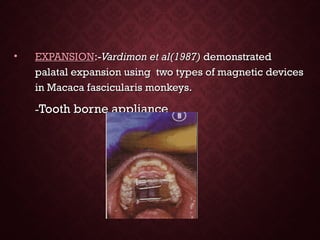 • EXPANSIONEXPANSION:-:-Vardimon et al(1987)Vardimon et al(1987) demonstrateddemonstrated
palatal expansion using two types of magnetic devicespalatal expansion using two types of magnetic devices
in Macaca fascicularis monkeys.in Macaca fascicularis monkeys.
--Tooth borne applianceTooth borne appliance
 