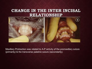 CHANGE IN THE INTER INCISALCHANGE IN THE INTER INCISAL
RELATIONSHIPRELATIONSHIP
Maxillary Protraction was related to A-P activity of the premaxillary suture
(primarily) & the transverse palatine suture (secondarily).
 