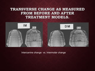 TRANSVERSE CHANGE AS MEASUREDTRANSVERSE CHANGE AS MEASURED
FROM BEFORE AND AFTERFROM BEFORE AND AFTER
TREATMENT MODELS.TREATMENT MODELS.
Intercanine change vs. Intermolar change
 