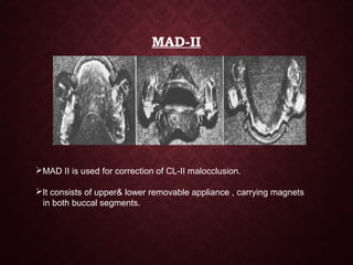 MAD-II
MAD II is used for correction of CL-II malocclusion.
It consists of upper& lower removable appliance , carrying magnets
in both buccal segments.
 