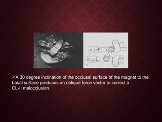A 30 degree inclination of the occlusal surface of the magnet to the
basal surface produces an oblique force vector to correct a
CL-II malocclusion.
 
