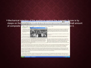 Mechanical retention of the appliance against the magnetic forces is by
clasps on the posterior teeth & in the anterior area by adding small amount
of composite on the labial surface so that the labial bow rests on it.
 
