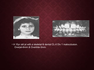 • A 10yr old pt with a skeletal & dental CL-II Div 1 malocclusion.
Overjet-6mm & Overbite-3mm.
 