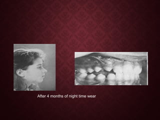 After 4 months of night time wear
 