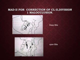 MAD-II FOR CORRECTION OF CL-II,DIVISIONMAD-II FOR CORRECTION OF CL-II,DIVISION
1 MALOCCLUSION.1 MALOCCLUSION.
Deep Bite
open Bite
 