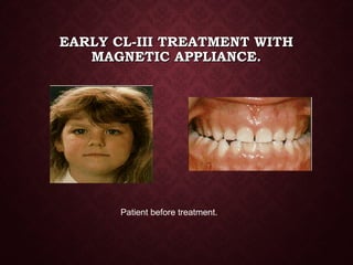 EARLY CL-III TREATMENT WITHEARLY CL-III TREATMENT WITH
MAGNETIC APPLIANCE.MAGNETIC APPLIANCE.
Patient before treatment.
 