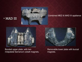 • MAD IIIMAD III
Combined MED & MAD III appliance
Bonded upper plate ,with two
midpalatal Samarium cobalt magnets.
Removable lower plate with buccal
magnets.
 