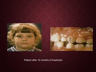 Patient after 14 months of treatment.
 
